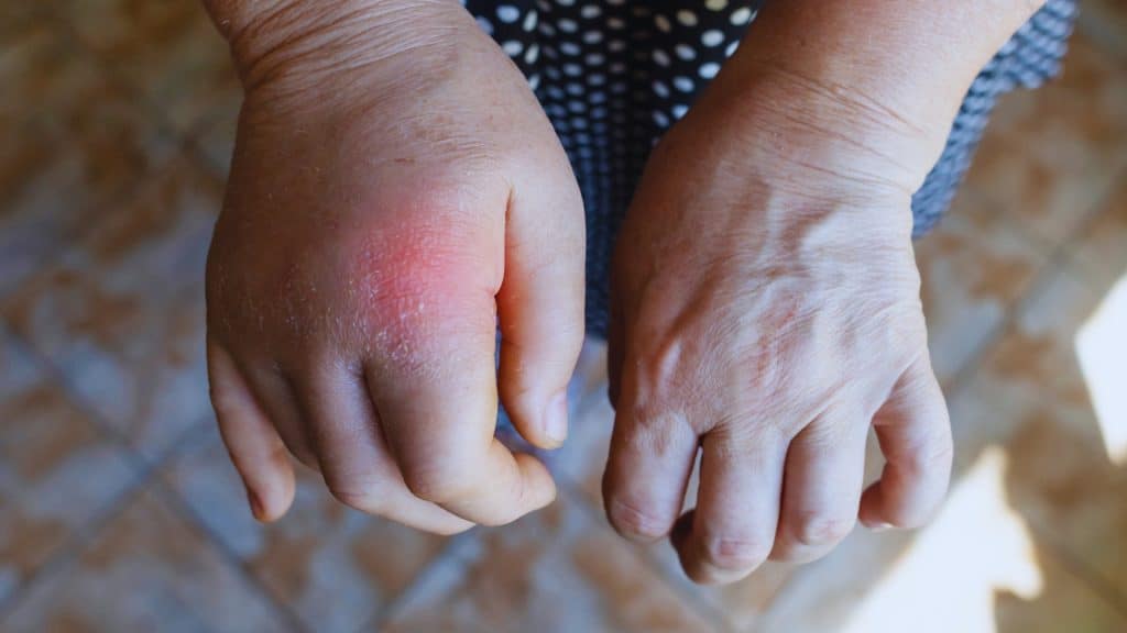 Inflammation Dairy relationship