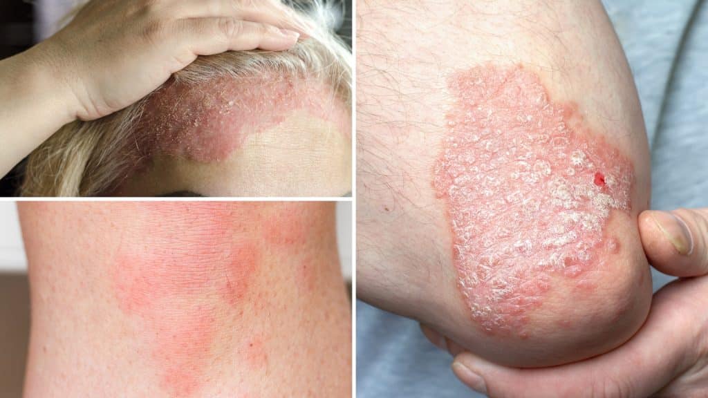 Skin Conditions Leaky Gut