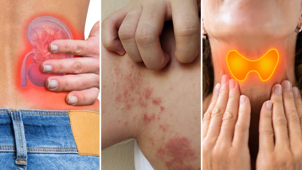 Homocysteine Remain High